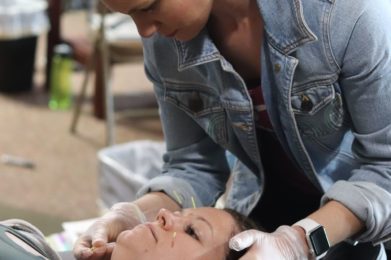 Facial dry Needling